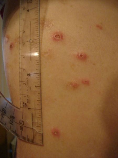 Erythema nodosum